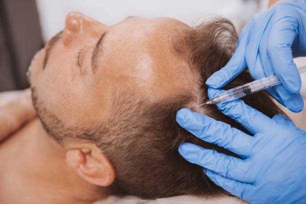 Hair PRP Therapy – Boost Your Hair from the Roots