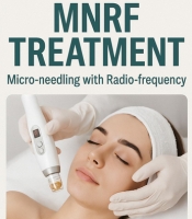 MNRF (Micro-needling with Radio-frequency)