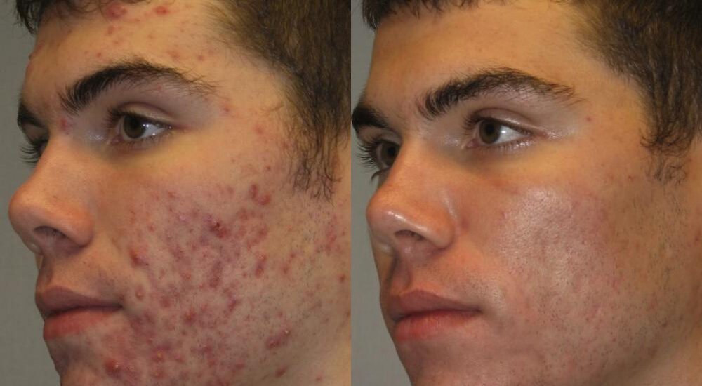 Acne Treatment That Actually Works for Clear Skin