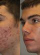 Acne Treatment That Actually Works for Clear Skin