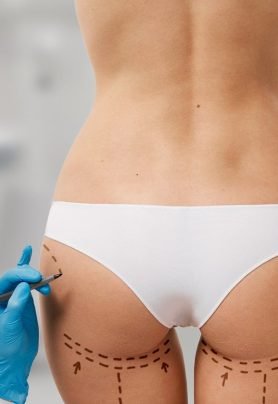 woman-marked-out-cosmetic-surgery (1)-min